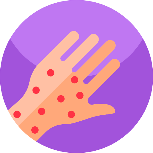 Smallpox