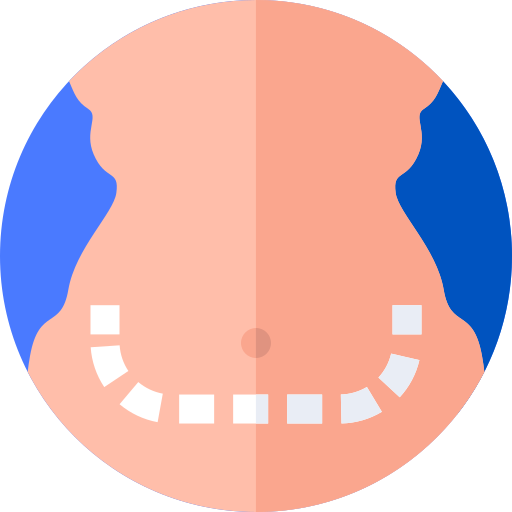 Abdominoplasty